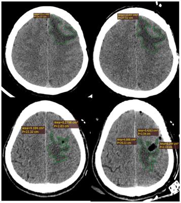 Effects of perioperative hydrogen inhalation on brain edema and prognosis in patients with glioma: a single-center, randomized controlled study